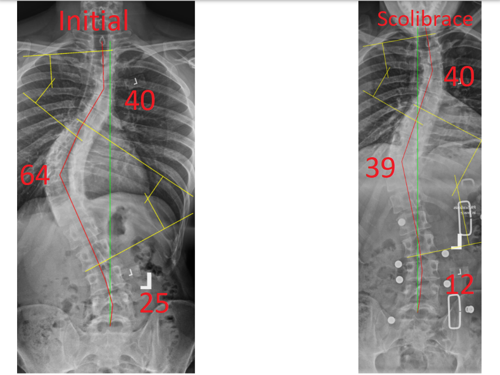 Scoliosis Degree of Curve Explanation Chart Chiropractor in St. Augustine
