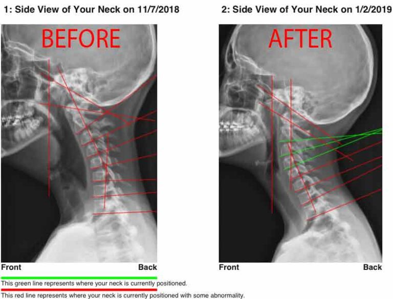Scoliosis Degree of Curve Explanation Chart Chiropractor in St. Augustine