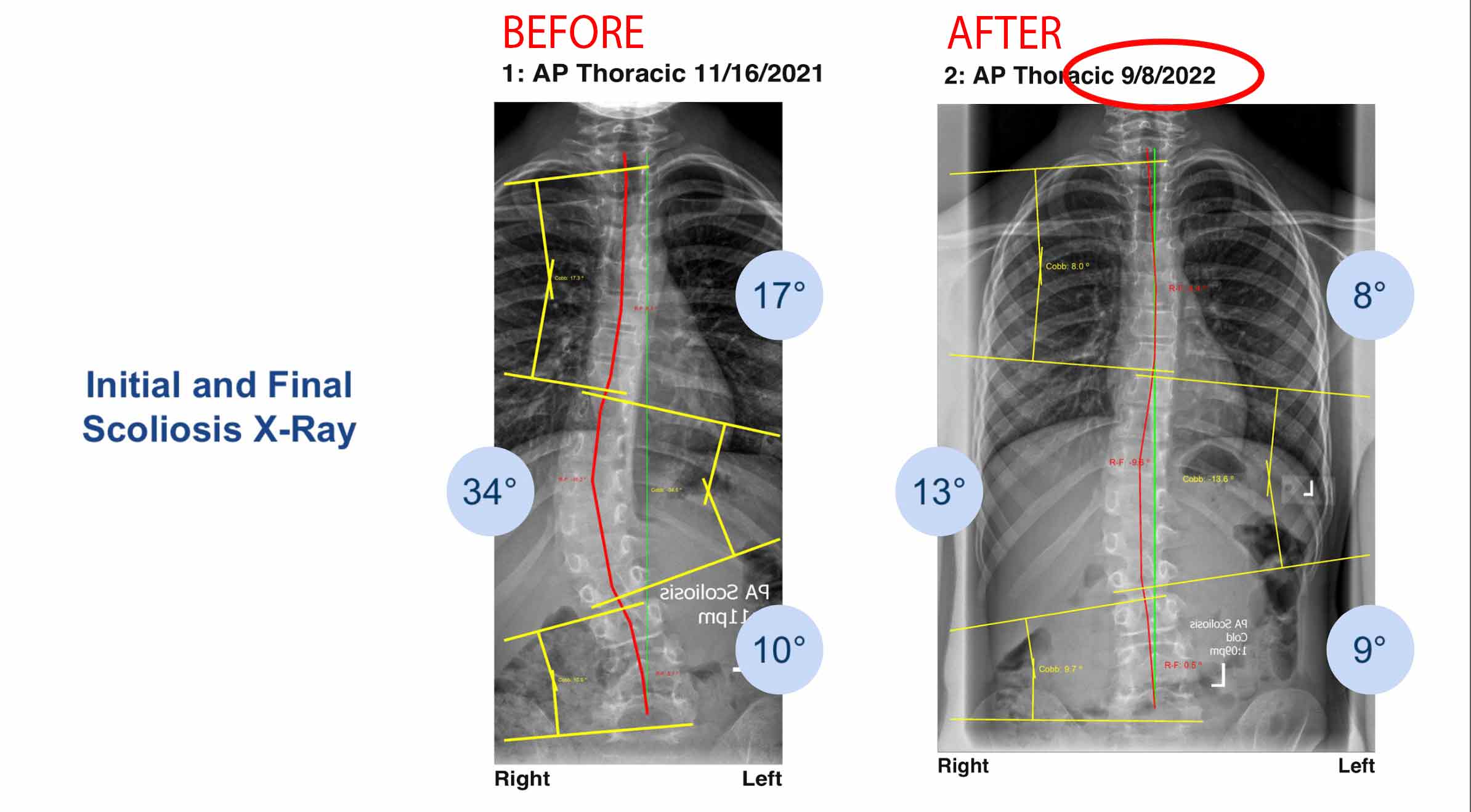 Scoliosis X-Ray before and after